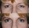 Before and after a blepharoplasty