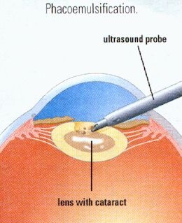 The ultrasound probe gently vacuums out the cataract