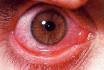 COnjunctivitis "pink eye"
