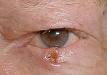 Basal cell carcinoma of the lower eyelid