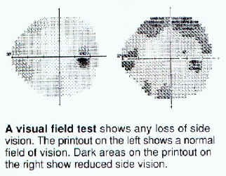 Visual field test demonstrating field loss