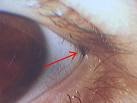 New abnormal eyelashes growing in the eyelid