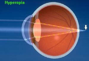 The focus point is behind the retina