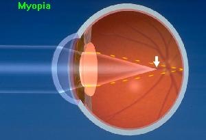 The focus point is in front of the retina